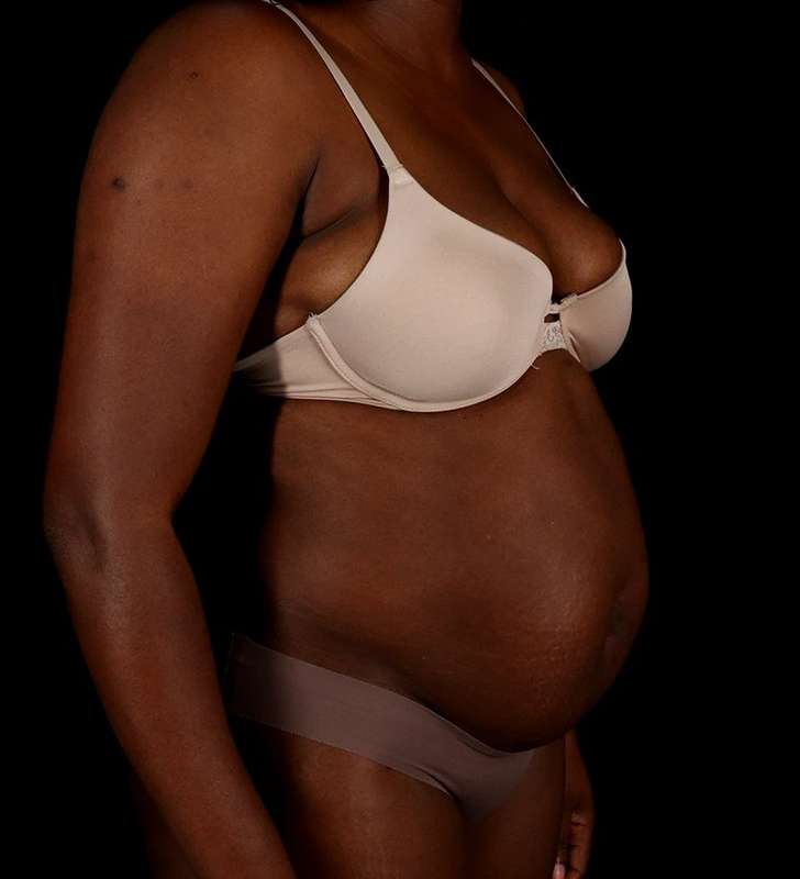 Tummy Tuck Before & After Patient #2448