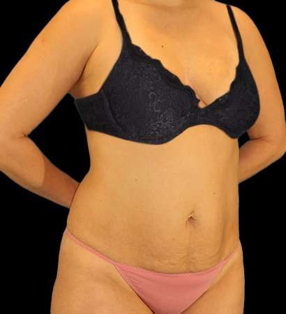 Tummy Tuck Before & After Patient #2485