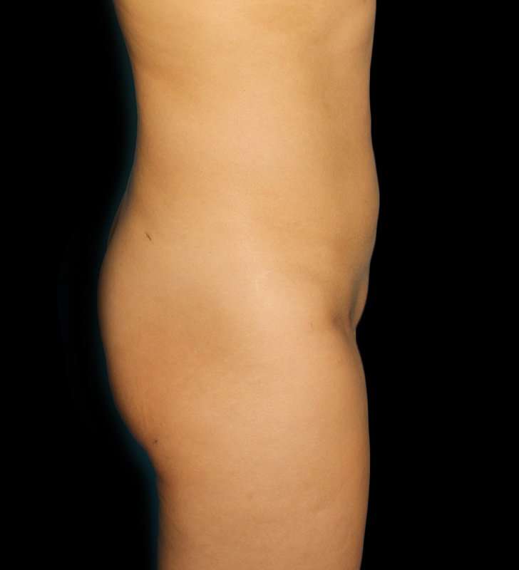 Brazilian Butt Lift Before & After Patient #2496