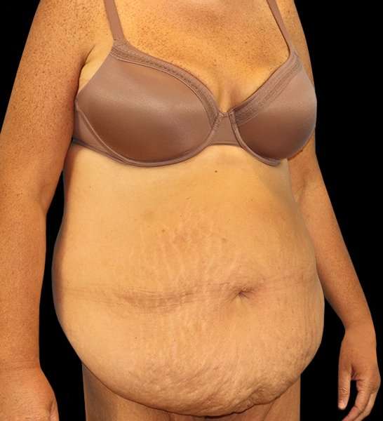 Circumferential Body Lift Before & After Patient #2509
