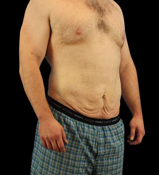 Circumferential Body Lift Before & After Patient #2522