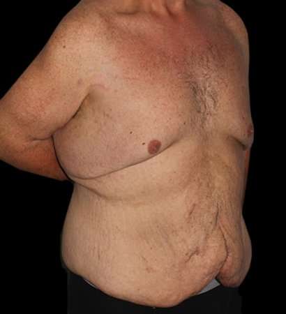 Massive Weight Loss Before & After Patient #5155