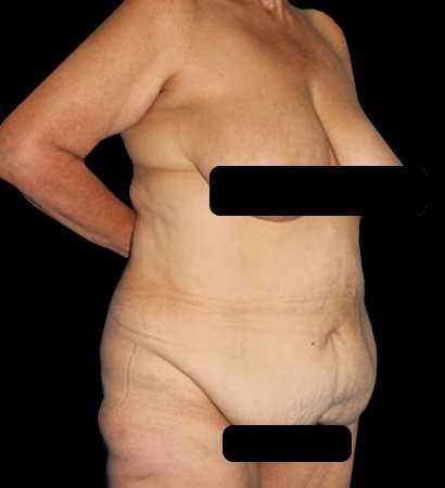 Circumferential Body Lift Before & After Patient #2572