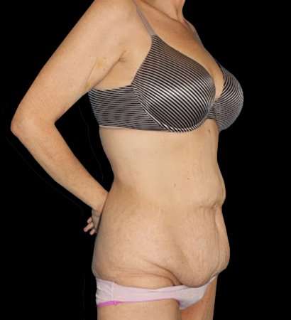 Circumferential Body Lift Before & After Patient #2598