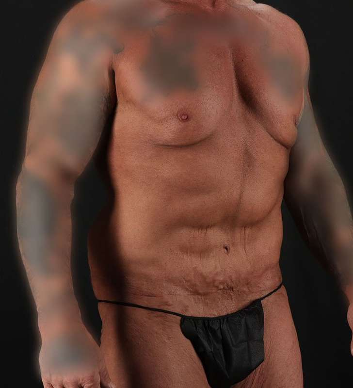 Circumferential Body Lift Before & After Patient #2611