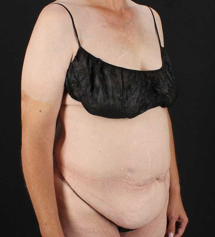 Circumferential Body Lift Before & After Patient #2624