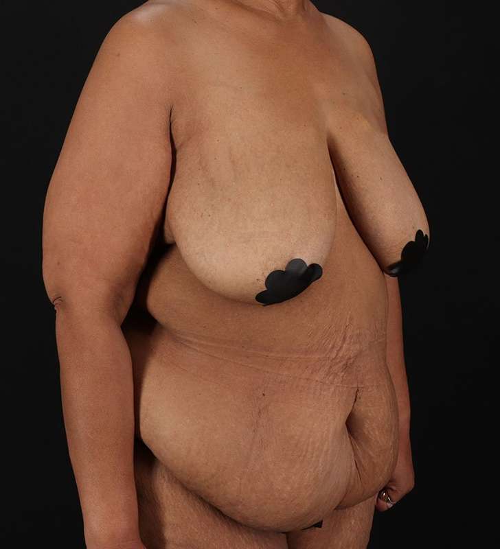 Circumferential Body Lift Before & After Patient #2637