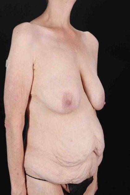 Circumferential Body Lift Before & After Patient #2663
