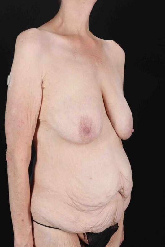 Circumferential Body Lift Before & After Patient #2663