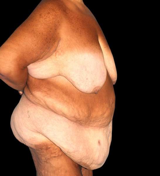 Fleur De Lis Circumferential Body Lift Before & After Patient #2674