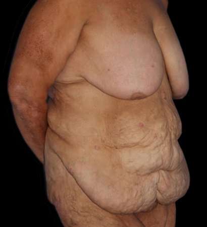 Fleur De Lis Circumferential Body Lift Before & After Patient #2685