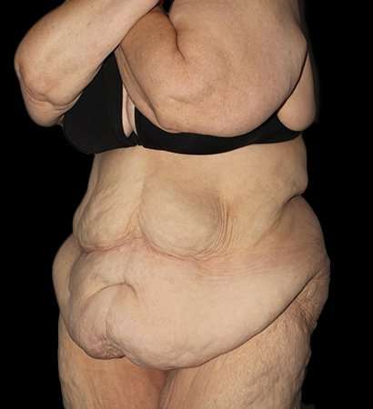 Fleur De Lis Tummy Tuck Before & After Patient #2692