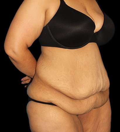 Fleur De Lis Tummy Tuck Before & After Patient #2703