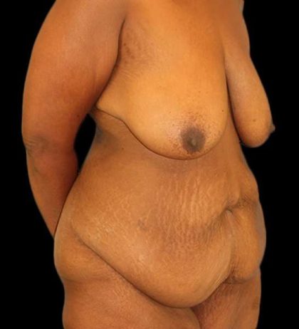 Fleur De Lis Tummy Tuck Before & After Patient #2714