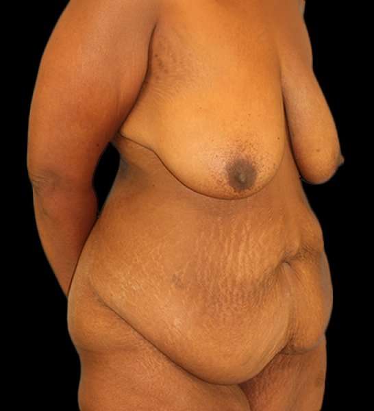 Fleur De Lis Tummy Tuck Before & After Patient #2714