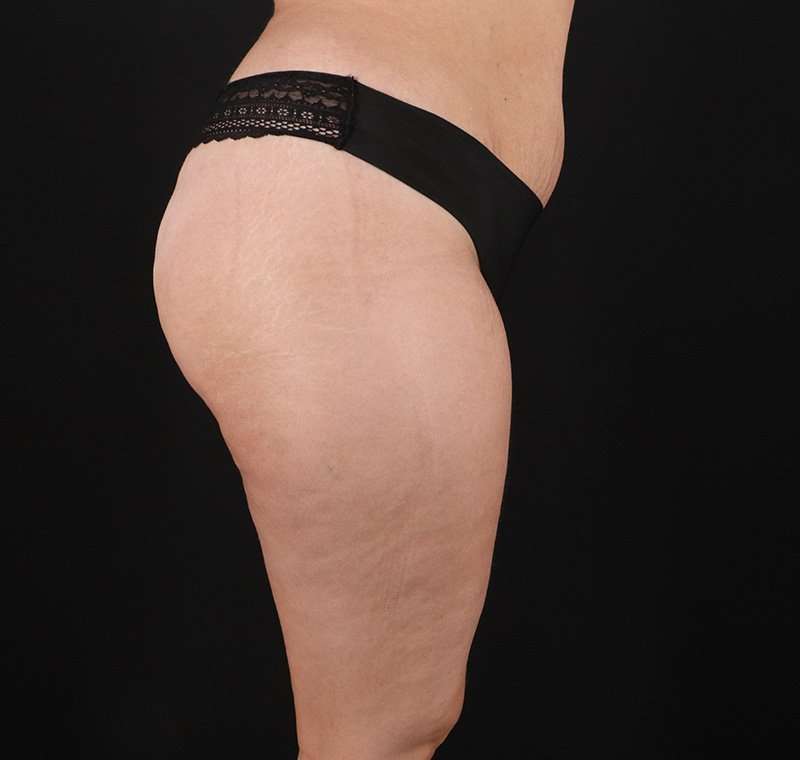 Liposuction Before & After Patient #2736