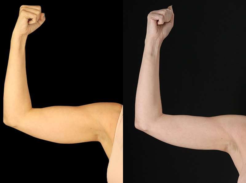 Liposuction Before & After Patient #2743