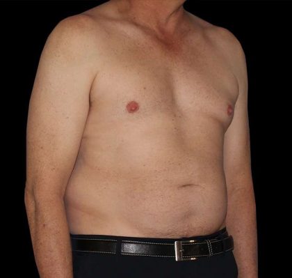 Liposuction Before & After Patient #2756