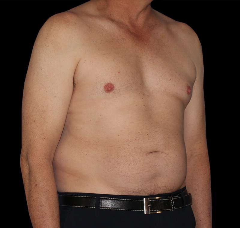 Liposuction Before & After Patient #2756