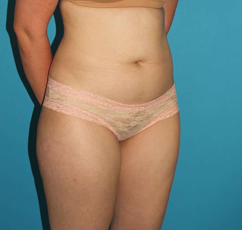 Liposuction Before & After Patient #2767