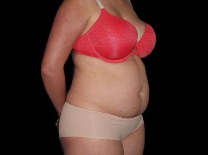 Liposuction Before & After Patient #2778