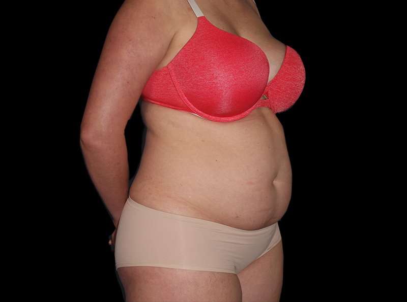 Liposuction Before & After Patient #2778