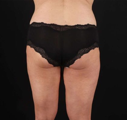 Liposuction Before & After Patient #2816
