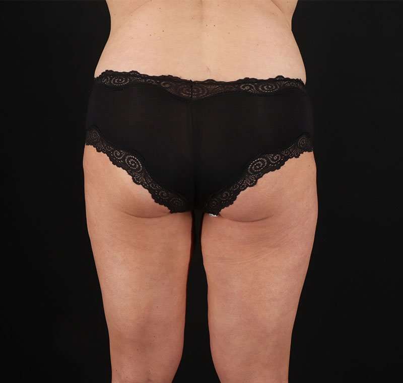Liposuction Before & After Patient #2816