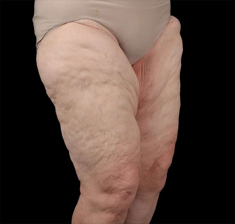Liposuction Before & After Patient #2829