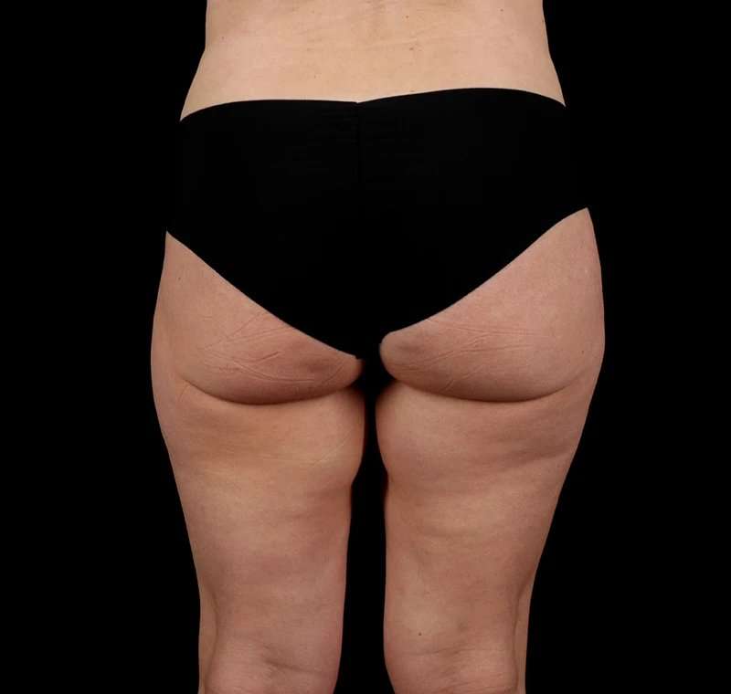 Liposuction Before & After Patient #2834