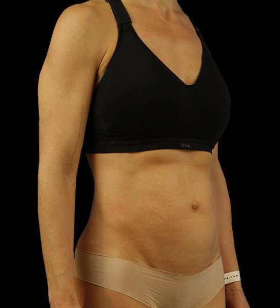 Mini Tummy Tuck Before & After Patient #2856