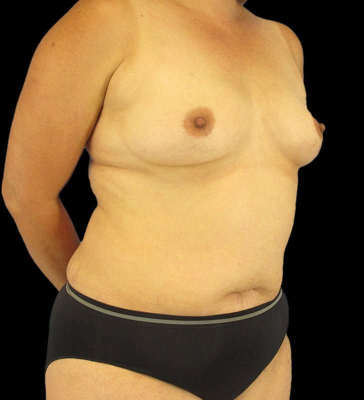 Mommy Makeover Before & After Patient #2878