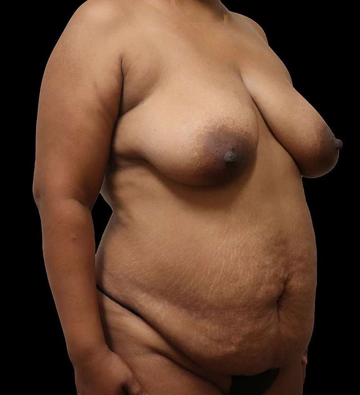 Mommy Makeover Before & After Patient #2926