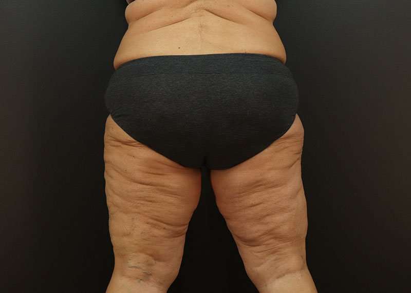 Thigh Lift Before & After Patient #2979
