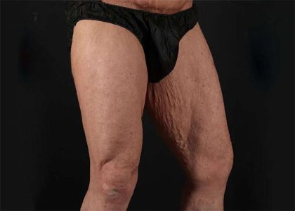 Thigh Lift Before & After Patient #2992