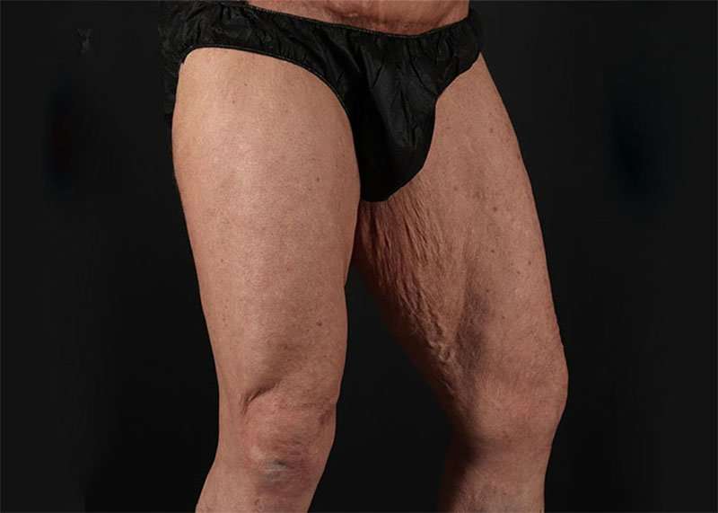 Thigh Lift Before & After Patient #2992