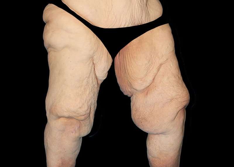Thigh Lift Before & After Patient #3005