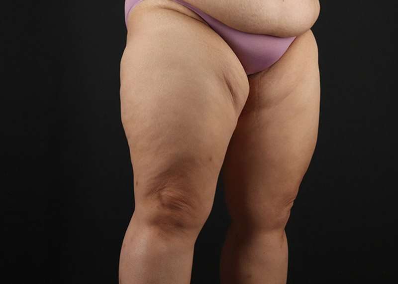 Thigh Lift Before & After Patient #3018