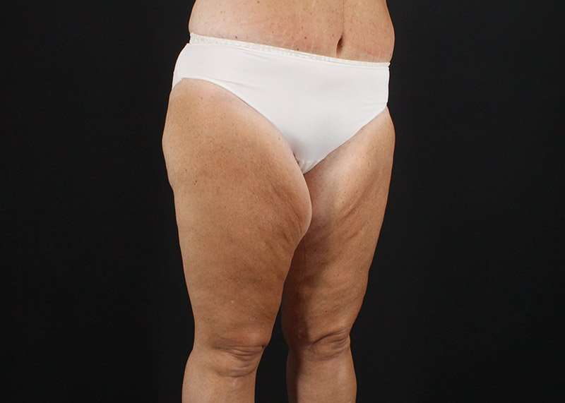 Thigh Lift Before & After Patient #3031