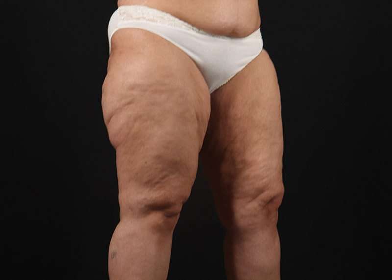 Thigh Lift Before & After Patient #3044