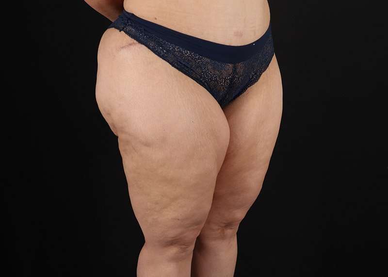 Thigh Lift Before & After Patient #3057
