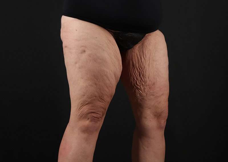 Thigh Lift Before & After Patient #3070