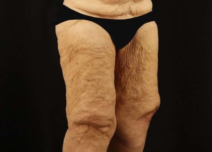Thigh Lift Before & After Patient #3083