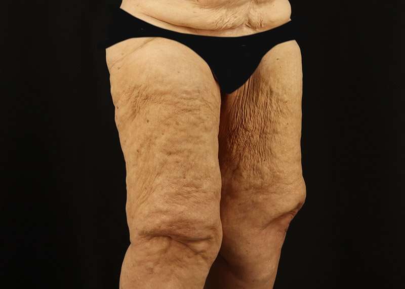 Thigh Lift Before & After Patient #3083