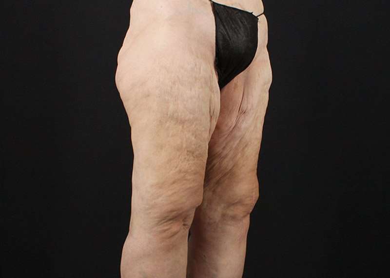 Thigh Lift Before & After Patient #3096
