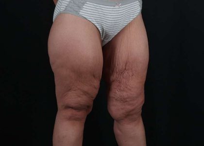 Thigh Lift Before & After Patient #3109