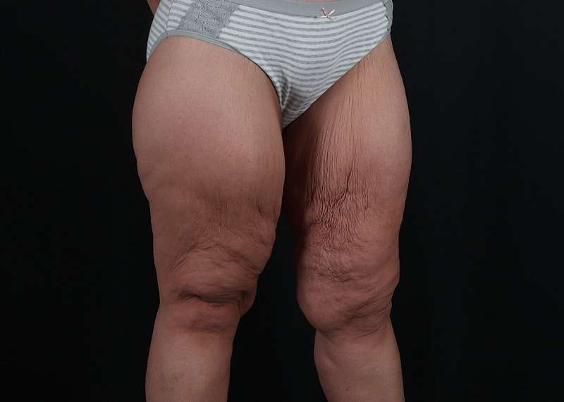 Thigh Lift Before & After Patient #3109
