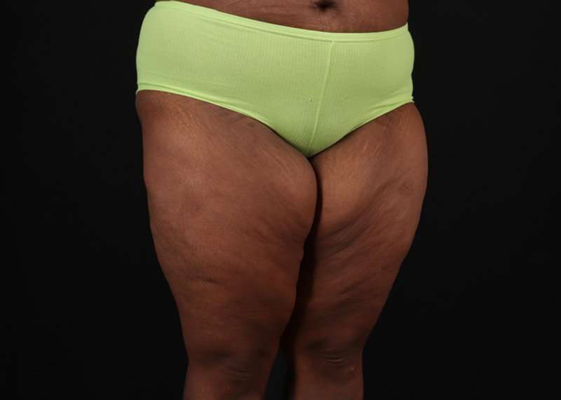 Thigh Lift Before & After Patient #3122