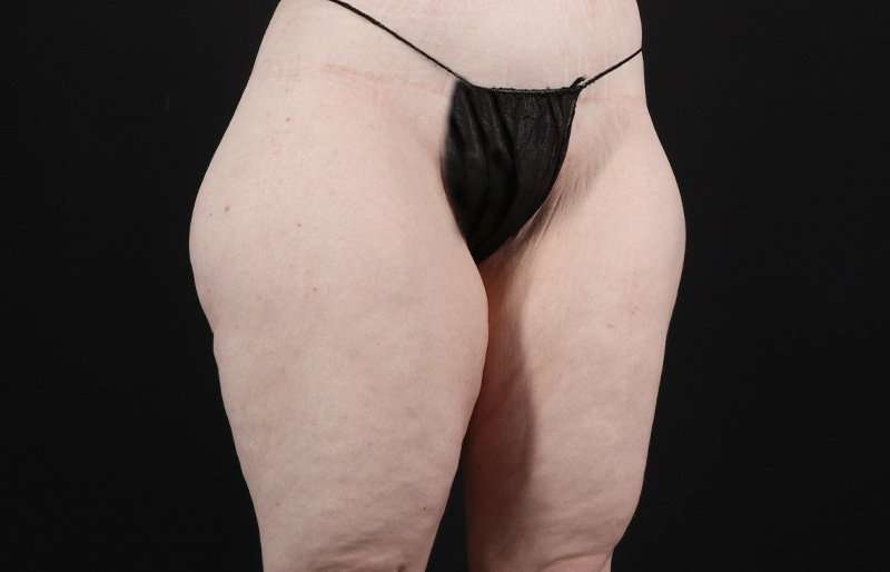 Thigh Lift Before & After Patient #3135