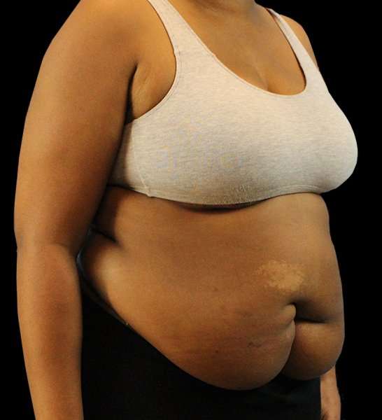 Tummy Tuck Revision Before & After Patient #3146